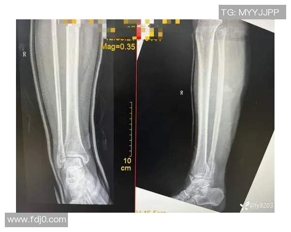 踝关节骨折影响职业生涯的足球明星们的奋斗与复苏故事